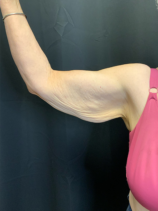 Arm Lift Before & After Image