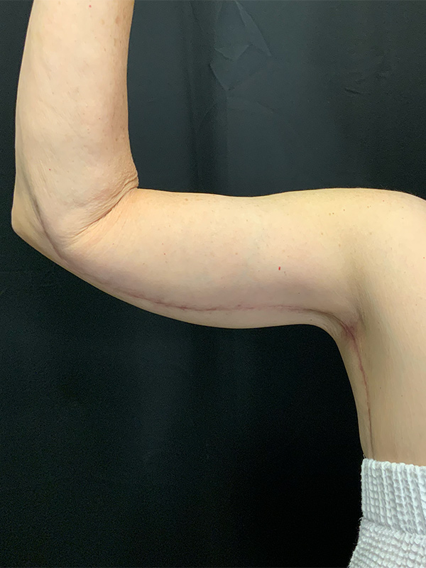 Arm Lift Before & After Image