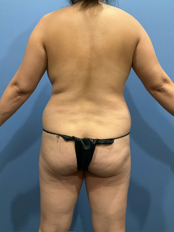 Brazilian Butt Lift Before & After Image