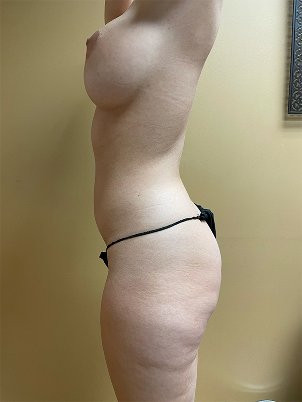 Brazilian Butt Lift Before & After Image