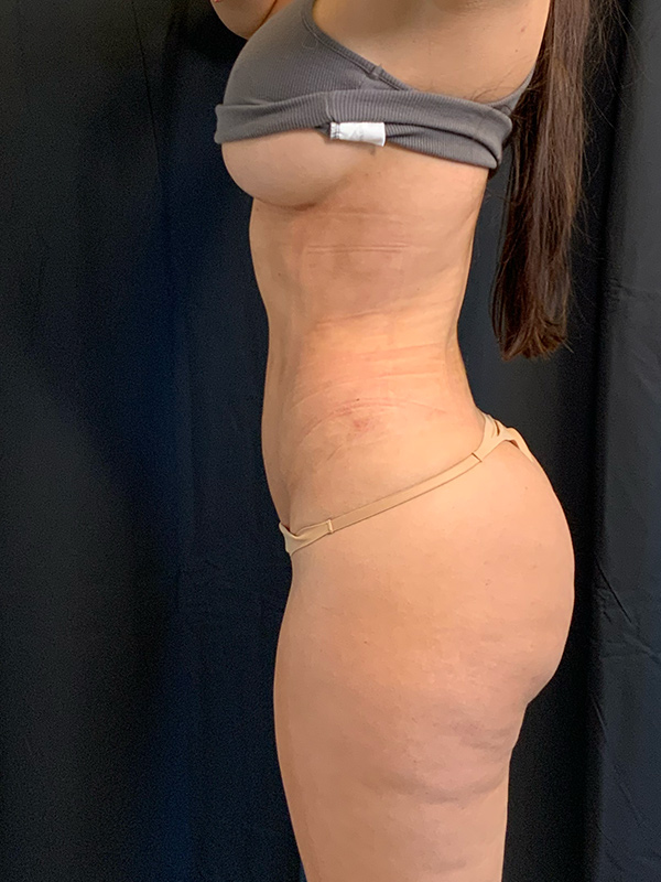 Brazilian Butt Lift Before & After Image