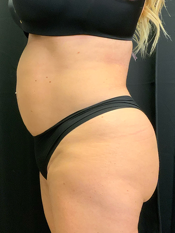 Brazilian Butt Lift Before & After Image