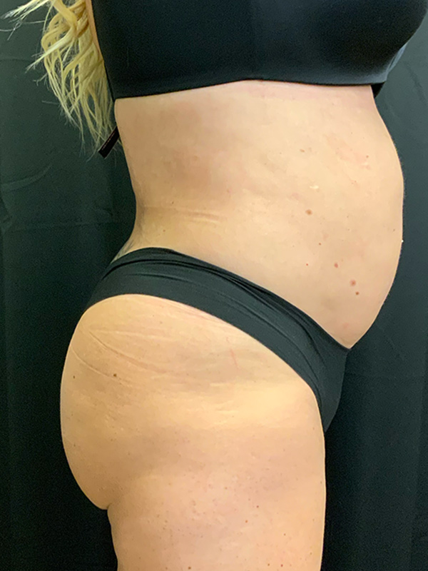 Brazilian Butt Lift Before & After Image