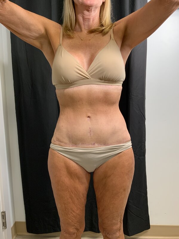 Tummy Tuck Before & After Image