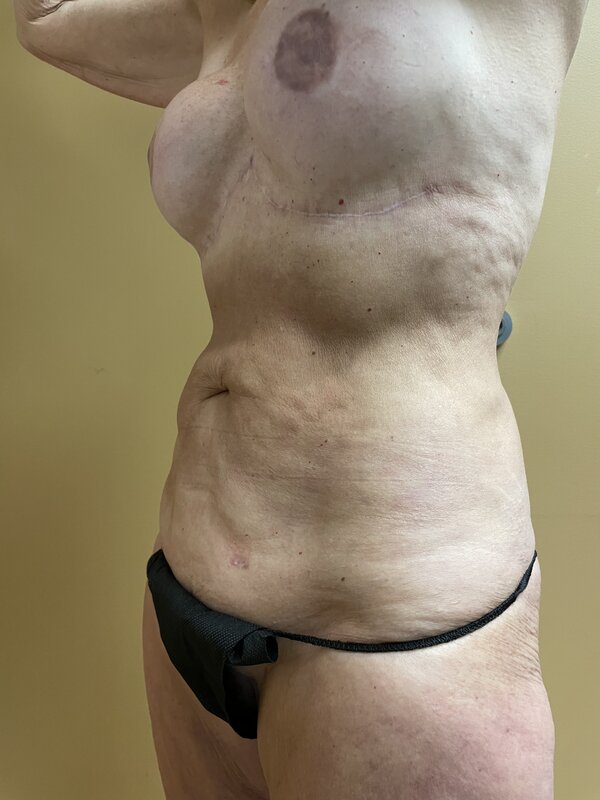 Tummy Tuck Before & After Image