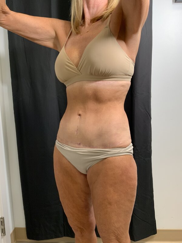 Tummy Tuck Before & After Image