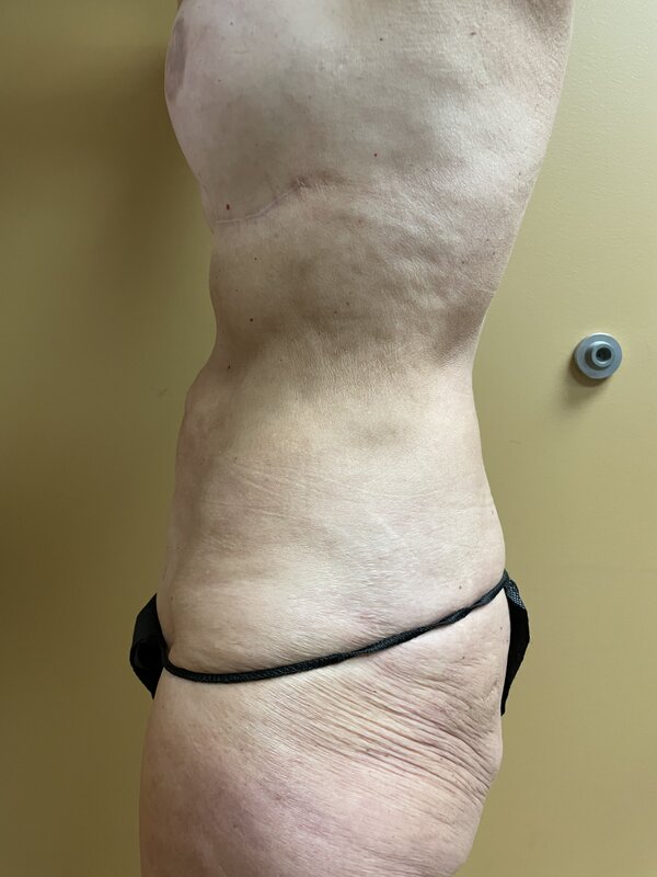 Tummy Tuck Before & After Image