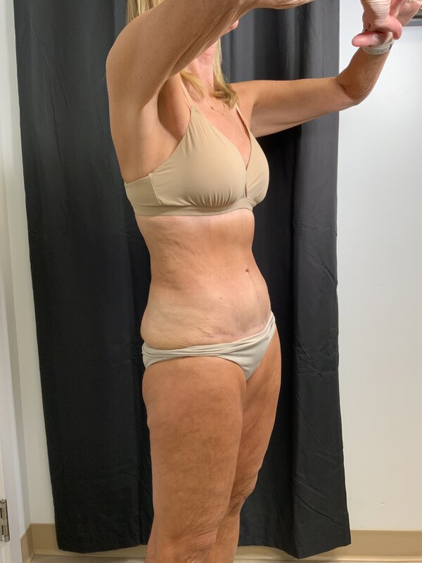 Tummy Tuck Before & After Image