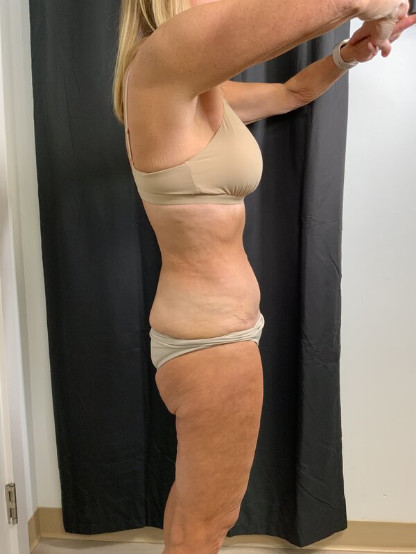 Tummy Tuck Before & After Image