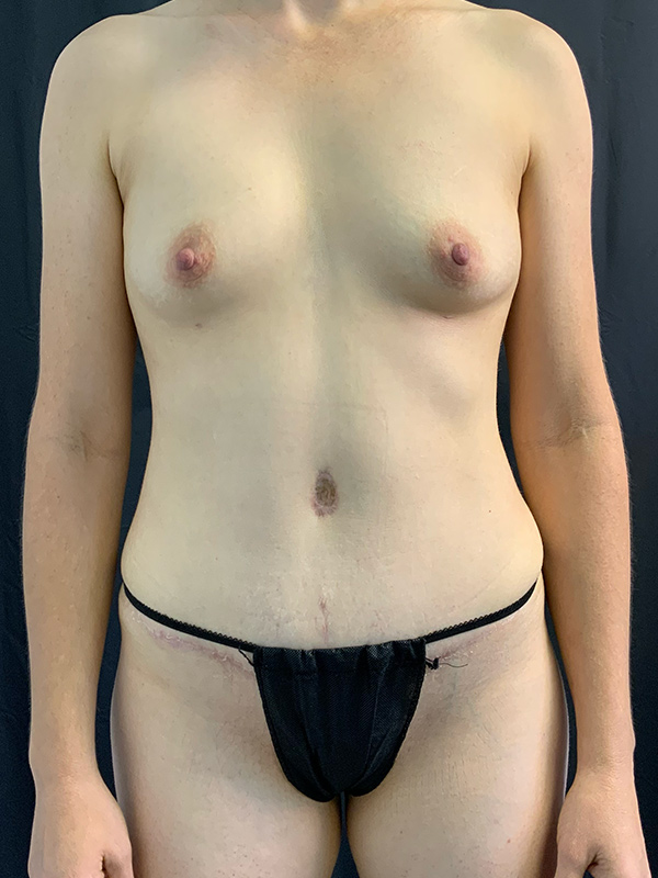 Tummy Tuck Before & After Image