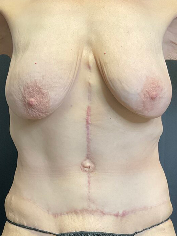 Tummy Tuck Before & After Image