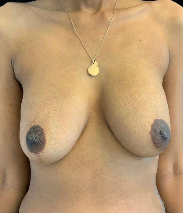 Breast Lift Mastopexy Before & After Image