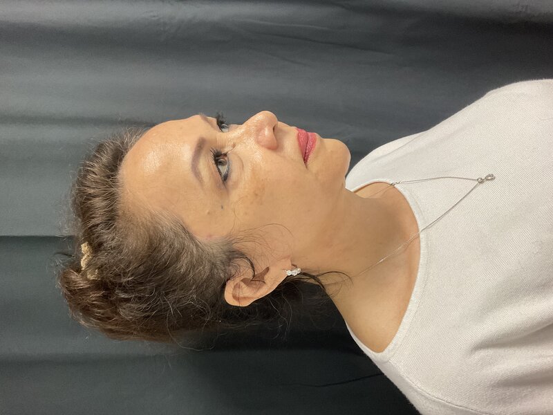 Deep Plane Facelift Before & After Image