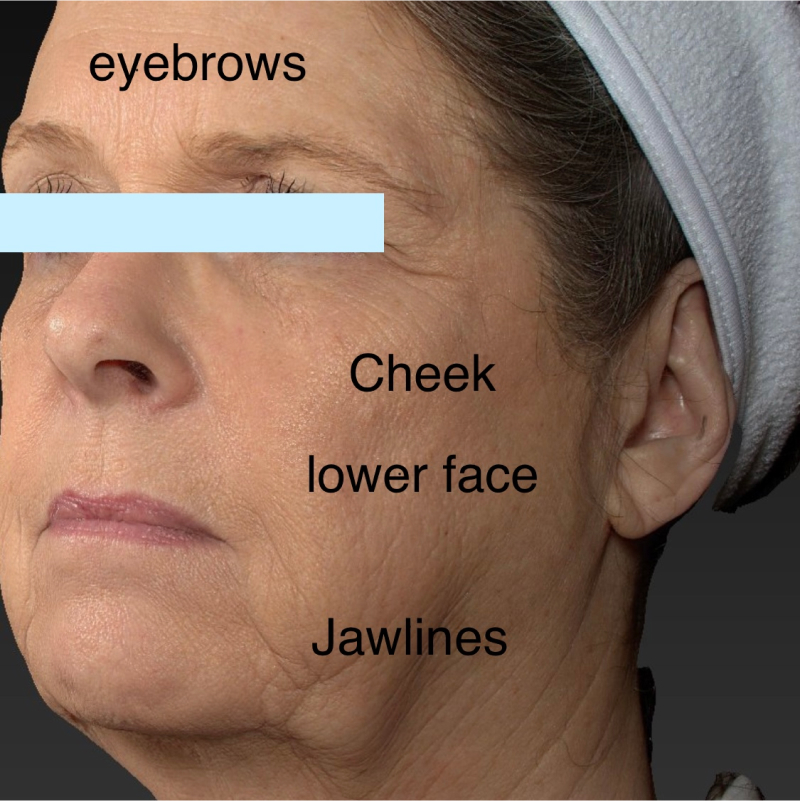 Deep Plane Facelift Before & After Image