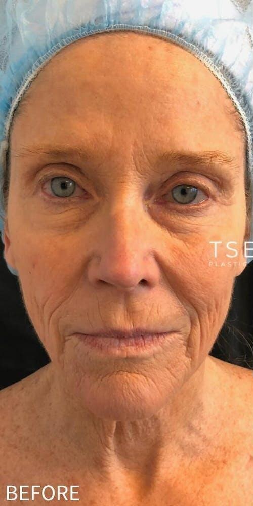 Deep Plane Facelift Before & After Image