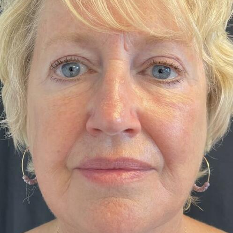 Deep Plane Facelift Before & After Image