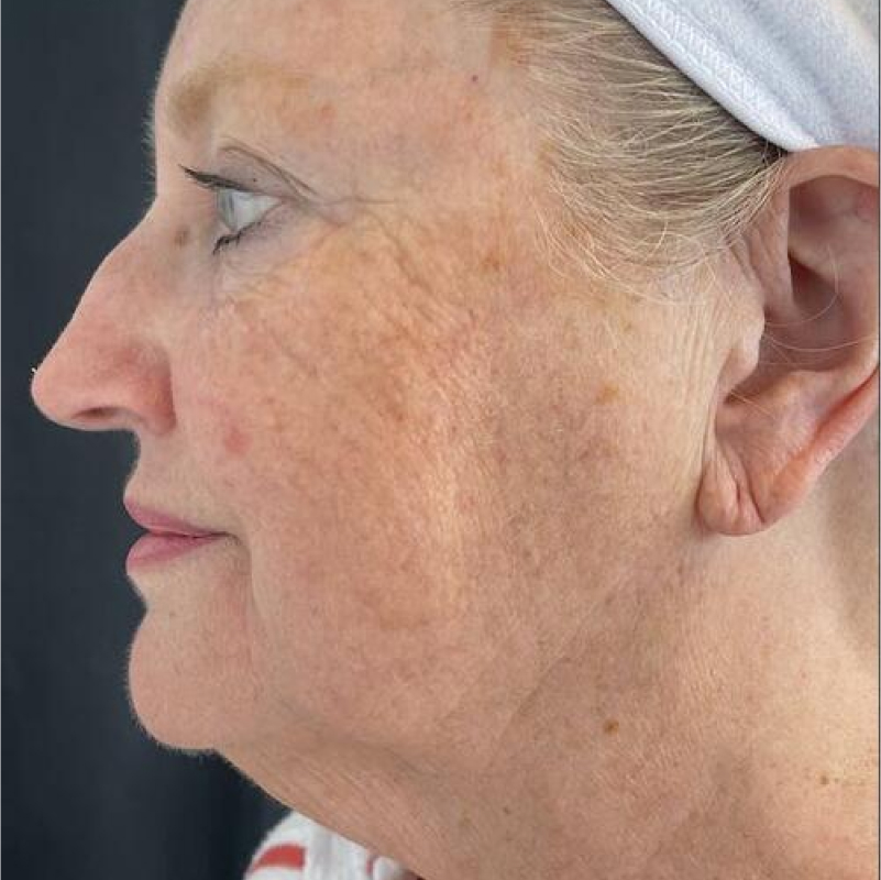 Deep Plane Facelift Before & After Image