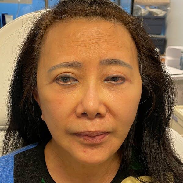 Deep Plane Facelift Before & After Image