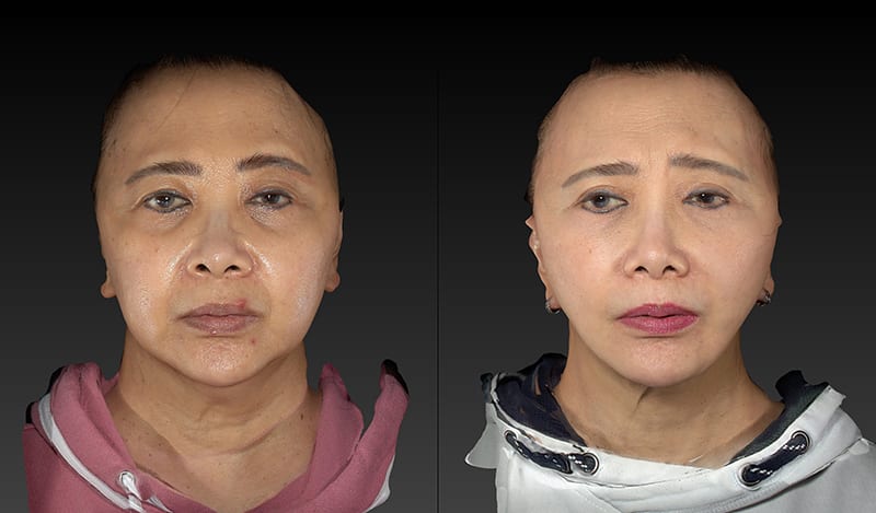 Deep Plane Facelift Before & After Image