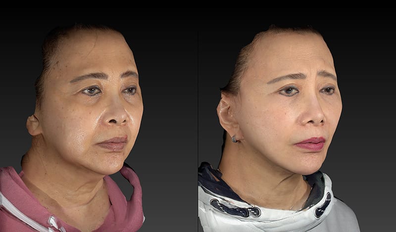 Deep Plane Facelift Before & After Image