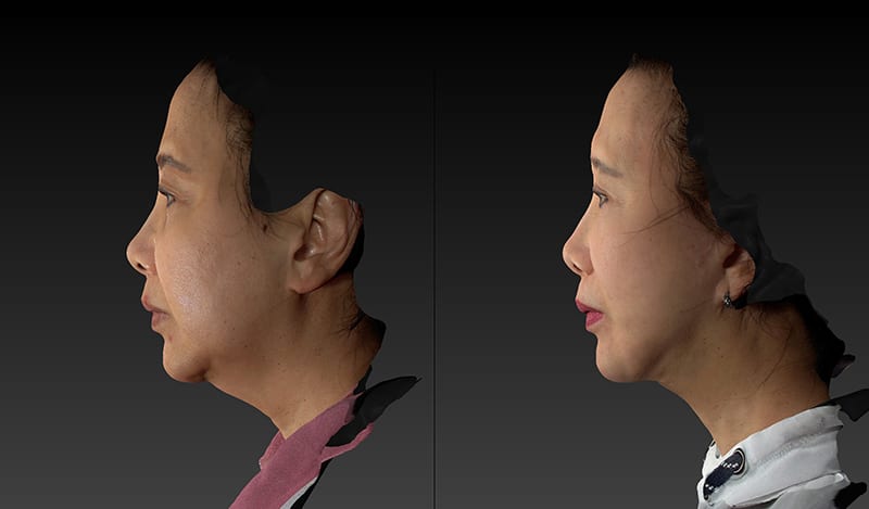 Deep Plane Facelift Before & After Image