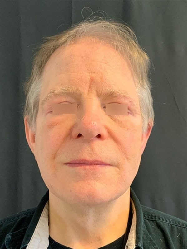 Deep Plane Facelift Before & After Image