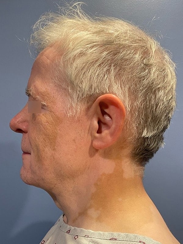 Deep Plane Facelift Before & After Image