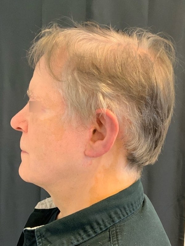 Deep Plane Facelift Before & After Image