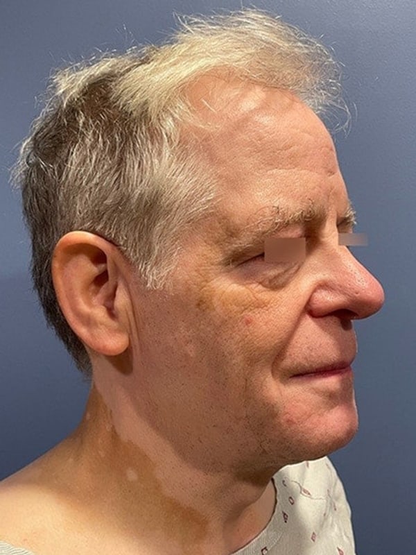 Deep Plane Facelift Before & After Image