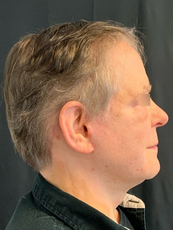 Deep Plane Facelift Before & After Image