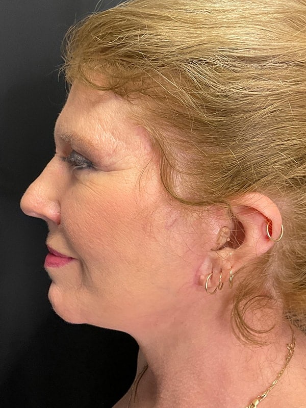 Deep Plane Facelift Before & After Image