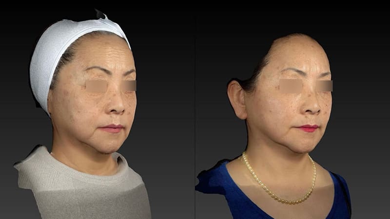 Deep Plane Facelift Before & After Image