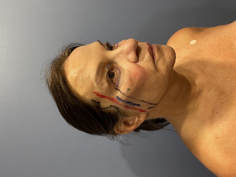 Deep Plane Facelift Before & After Image