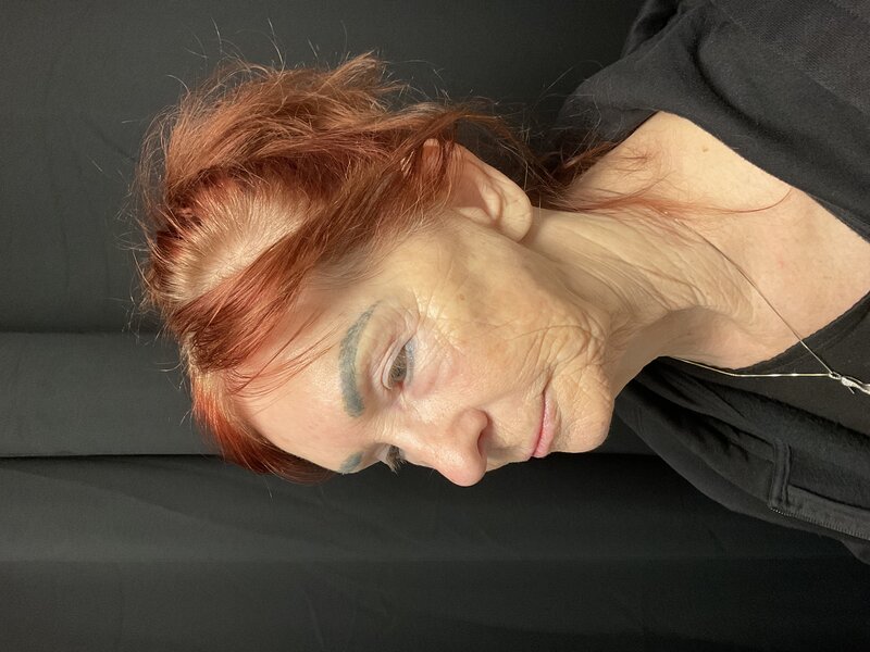 Deep Plane Facelift Before & After Image