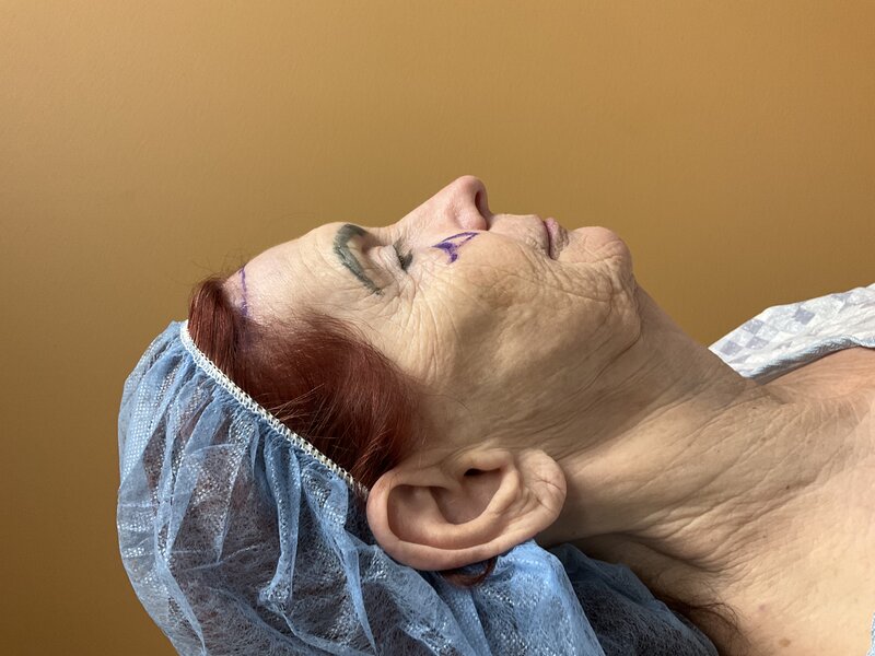 Deep Plane Facelift Before & After Image