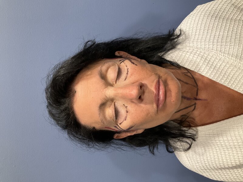 Deep Plane Facelift Before & After Image