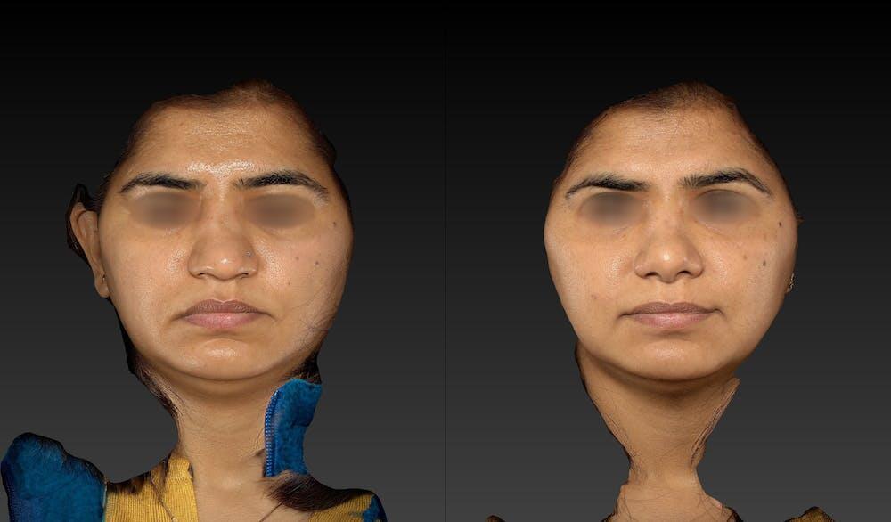 Ethnic Rhinoplasty Before & After Image