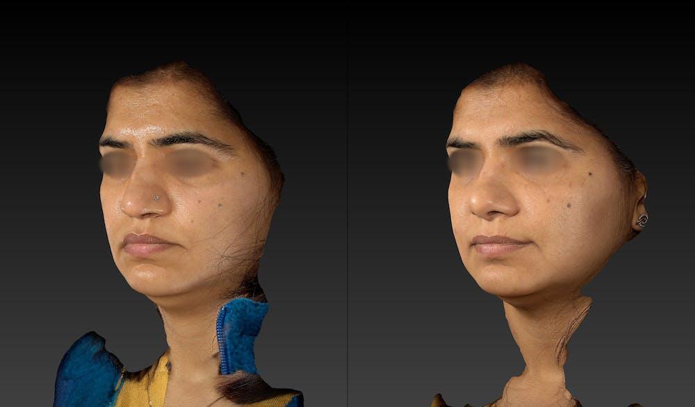 Ethnic Rhinoplasty Before & After Image