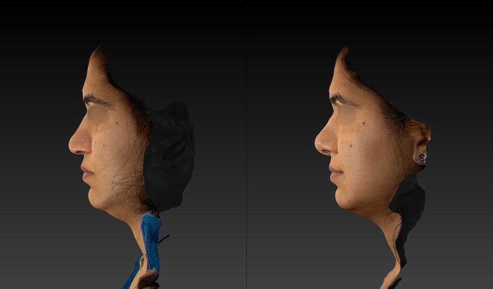 Ethnic Rhinoplasty Before & After Image