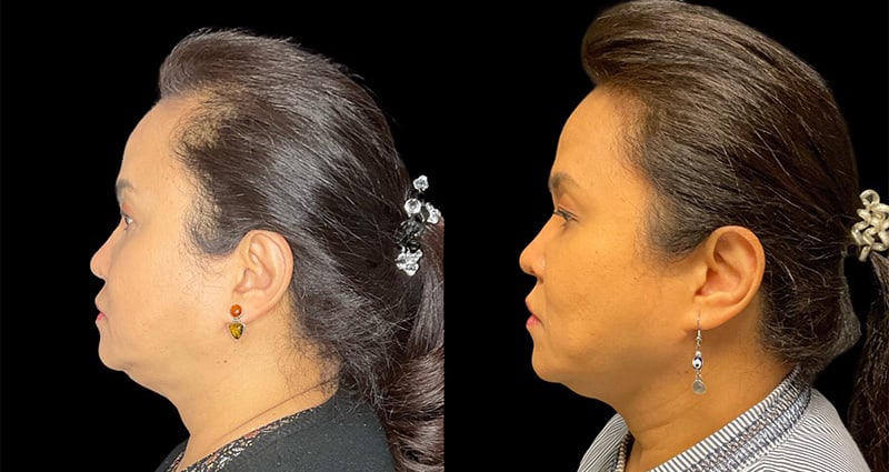 Ethnic Rhinoplasty Before & After Image