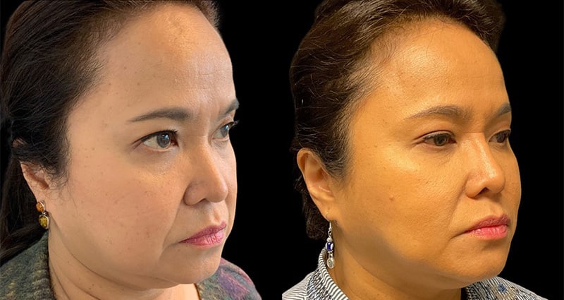 Ethnic Rhinoplasty Before & After Image