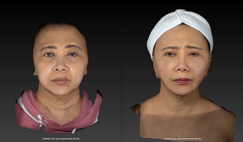 Ethnic Rhinoplasty Before & After Image