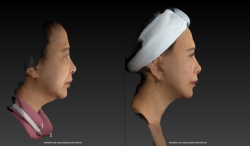 Ethnic Rhinoplasty Before & After Image