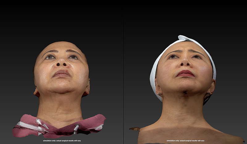 Ethnic Rhinoplasty Before & After Image