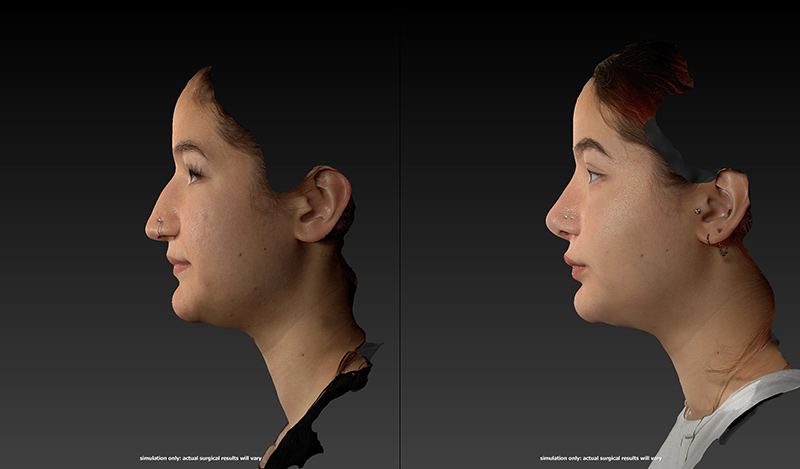 Ethnic Rhinoplasty Before & After Image