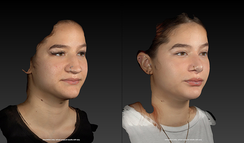 Ethnic Rhinoplasty Before & After Image