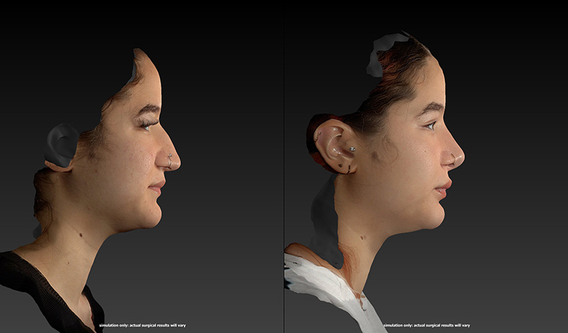 Ethnic Rhinoplasty Before & After Image