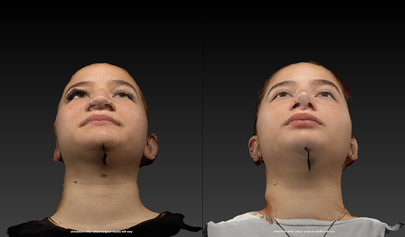 Ethnic Rhinoplasty Before & After Image