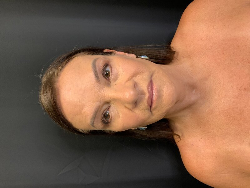 Facelift Before & After Image