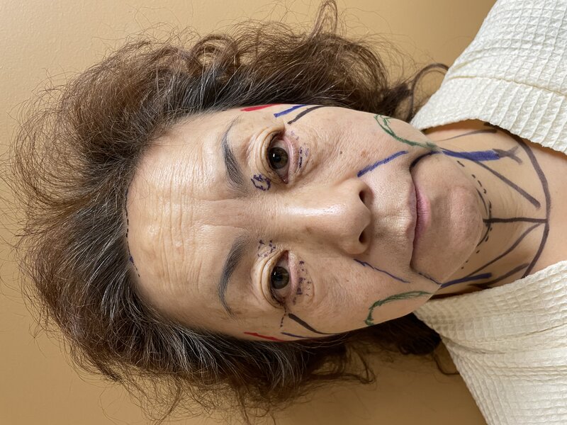 Facelift Before & After Image